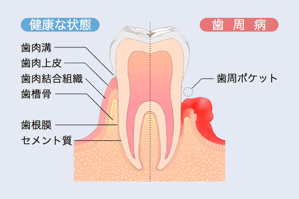 歯肉 炎 治療