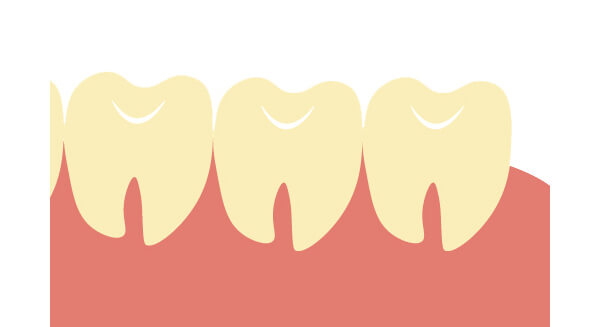 親知らず 抜歯 痛み いつまで